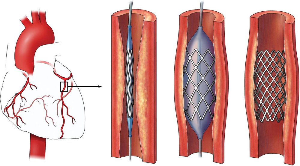 Percutaneous Coronary Intervention (PCI)/Coronary Angioplasty - MedEx